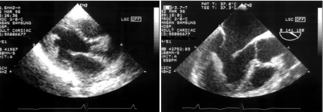 Fig. 2. Two-dimensional echocardiogram shows massive intracavitary echodense structure extends from left ven- ven-tricular apex to inflow tract (leftt：TTE, right：TEE)