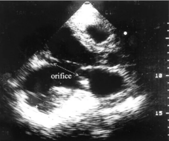 Fig. 2. The lateral chest radiography showed large  round mass (black arrow) projecting from the posterior  surface of the left ventricle
