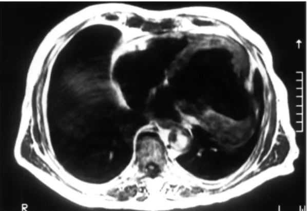 Fig. 4. Precontrast computed tomography of the heart showed large aneurysmal sac with the curvilinear calcifications in periphery