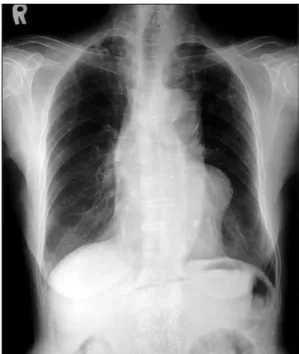 Fig. 2. Contrast-enhanced computed tomography sho- sho-ws a large well-defined mass, separate from heart  cha-mbers, which is enhanced to the same degree as the heart chambers