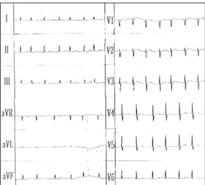Fig. 2. ECG during chest pain shows ST elevation in V2-V4. 