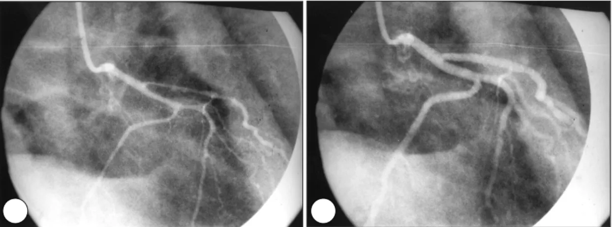 Fig. 5. The right coronary angiogram before thyroid medication. A：After dye injection, severe diffuse coronary spasm was evident