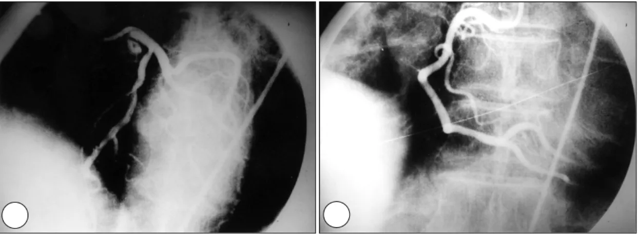 Fig. 6. Follow up coronary angiogram performed l year later. A：The left coronary artery after acetylcholine injection