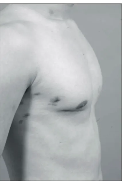 Fig. 2. Postoperative result of skin incision.