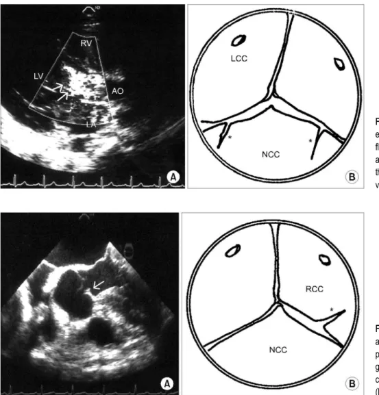 Fig. 2. Case 2 patient: Preoper- Preoper-ative echocardiogram shows  incom-petent of aortic valve (A) and  dia-gram showing tearing of the right coronary cusp of the aortic valve (B)