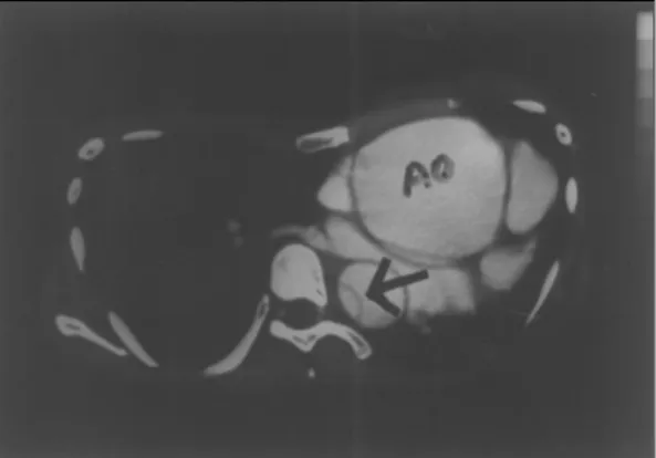 Fig. 4. Aortography showed marked dilatation of as- as-cending aorta and intimal flap with true and false lumen(arrow)