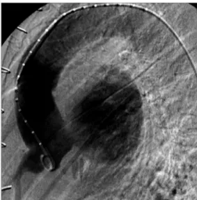 Fig. 2. Preoperative aortography shows a huge saccular aneurysm originating from left coronary artery ostium.