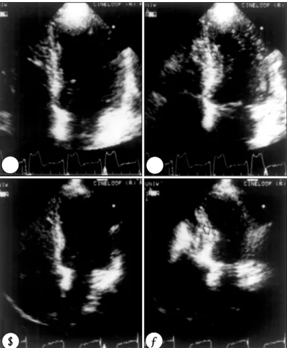 Fig. 4. An example of post-pac- post-pac-ing regional wall motion  abnorm-alities. Hypokinesia are noted on the apical and mid septum (A &amp;