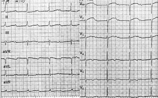 Fig. 1. Surface electrocardiogram obtained immediately after syncope at emergency room