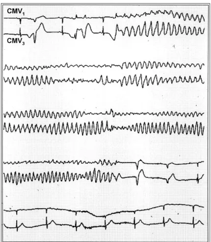 Fig. 4. Relation between QT interval and heart rate in this patient. The QT interval increased linearly when the heart rate was decreased