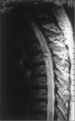 Fig. 4. Tissue from spinal cord T3-4, intramedullary area  shows the transposition from vein to artery(H &amp; E,  ×200)