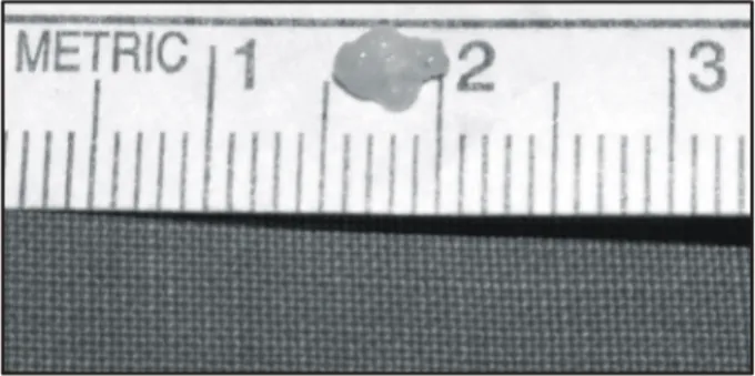 Fig. 2. Gross specimen of a papillary fibroelastoma after com- com-plete excision.