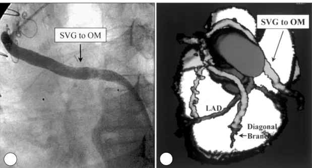 Fig. 2. A：coronary angiographic finding of a patient with patent bypass graft to the obtuse marginal branch.