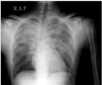 Fig. 2. Immediate post-extubation chest X-ray shows severe diffuse infiltration in both lung fields.