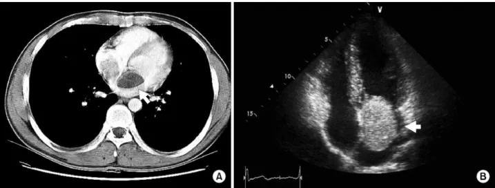 Fig. 2. Echocardiogram was done after 12 months of resection.