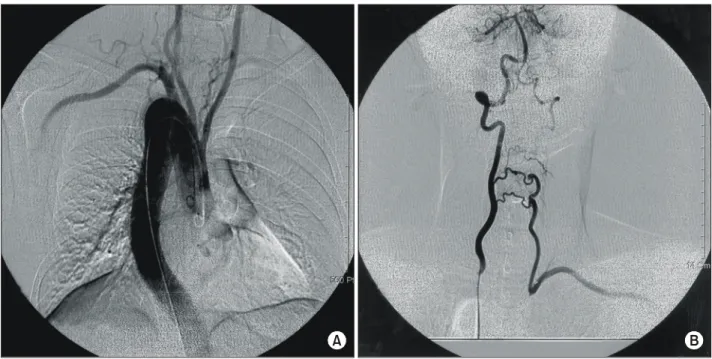 Fig. 2. The Kommerell’ diverticulum is compressing patient’s  esophagus, but there was no passage disturbance.