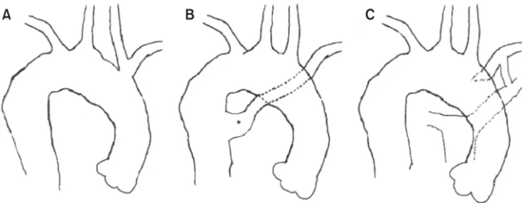 Fig. 4. Classification of right-sided arch anomalies. (A)  Type I, with mirror image arch branches