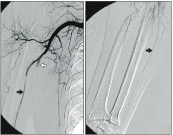 Fig. 4.  Angiography 17 days after operation shows recurrent attack of spastic vasoconstriction (arrow) and thrombotic occlusion of the  vascular  graft  (white arrow).