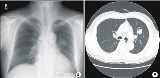 Fig. 1. Preoperative chest im- im-ages. Chest X-ray (A) and chest  CT (B) show pulmonary nodule  in left upper lobe.