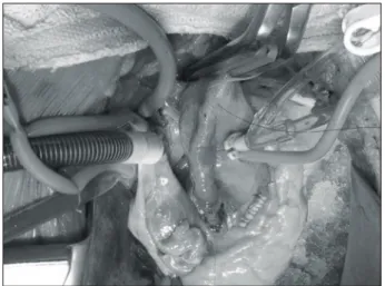 Fig. 3. Suture plication of the dilated ascending aorta by  continuous mattress suture using a first row of two rows of 4-0 polypropylene at an arrested heart.
