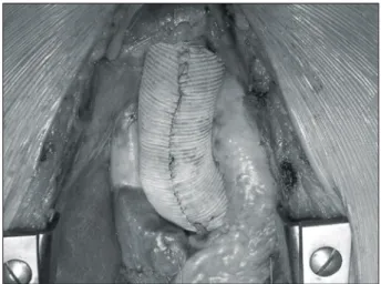 Fig. 5. External reinforcement of the ascending aorta using a  butterfly shaped vascular graft.