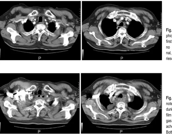 Fig. 2. Definite mediastinitis were noted in the computed tomography during second admission periods