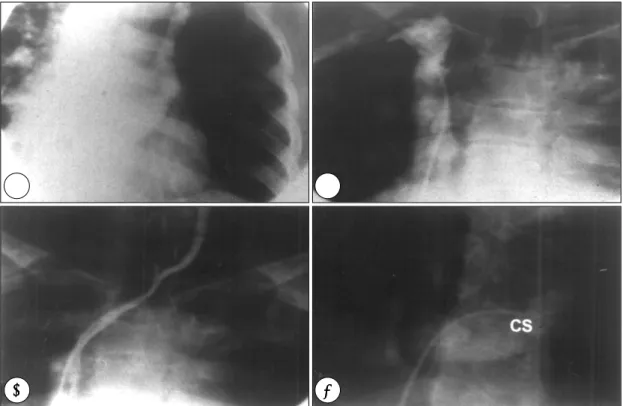 Fig. 4. Cardiac catheterization. A：Persistent left superior vena cava draining into dilated coronary sinus, B：