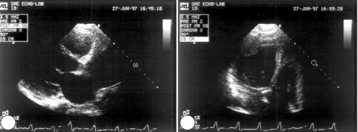 Fig. 1. Pre-operative end diastolic parasternal long axis (A) and apical four chamber (B) view