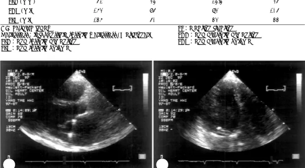 Fig. 2. Post-operative end diastolic parasternal long axis (A) and apical four chamber view (B)