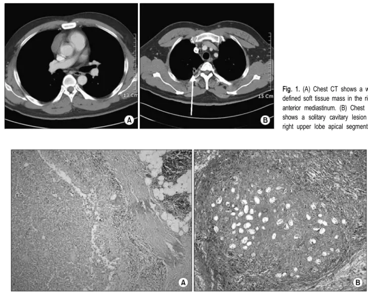Fig. 2. Histology (thymus and lung). (A) Eggs and inflammatory cells in the mediastinal mass (HN&amp;E×200)
