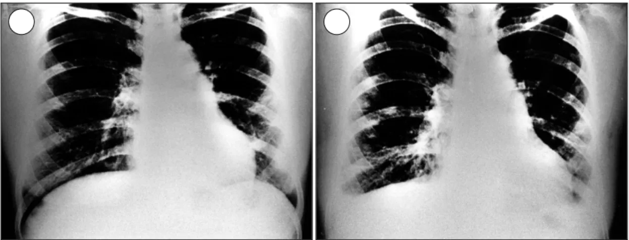 Fig. 1. A：Chest PA shows mild irregular increased opacities involving at base of the both lower lobe, especially left  lower lobe on admission