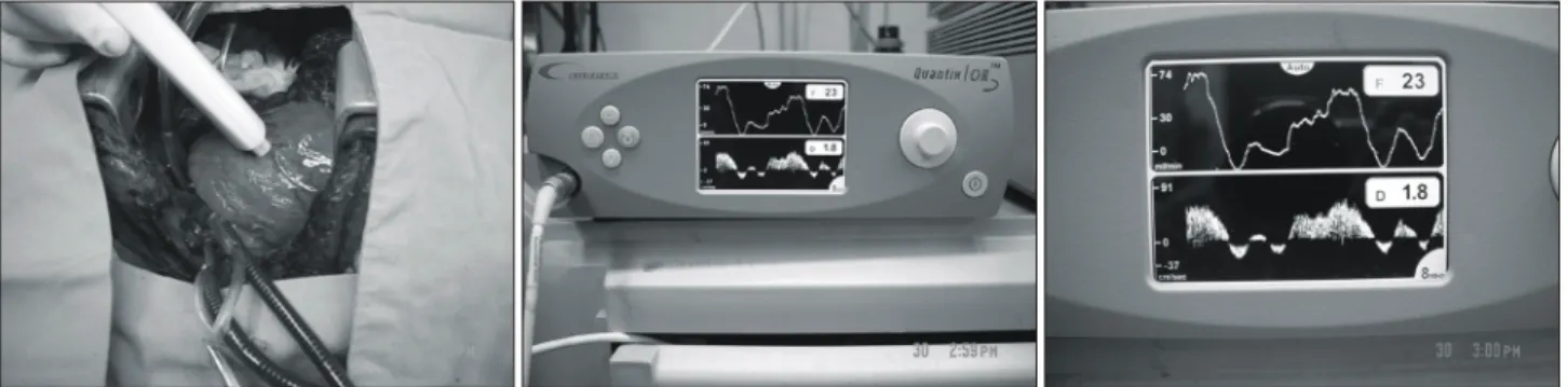 Fig. 1. Measurement of the coronary  artery blood flow using the ultrasonic flow-meter (Quantix/OR TM ) at the mid- LAD