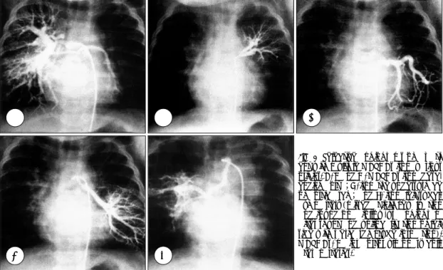 Fig. 8. Selective angiograms of a pati- pati-ent with multiple MAPCAs from various  origins