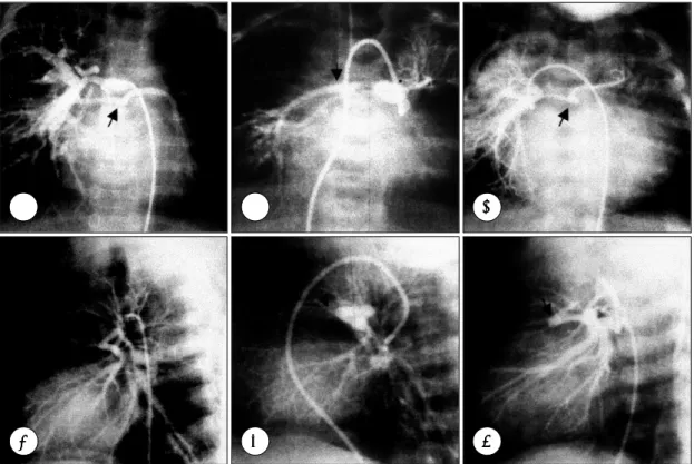 Fig. 1. Selective injections of contrast media to major aortopulmonary collateral arteries opacify hypoplastic central pulmonary arteries retrogradely (arrows)