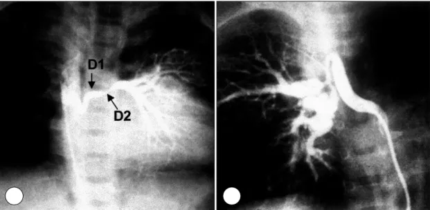Fig. 3. Selective angiograms of major aortopulmonary collateral arteries with stenoses