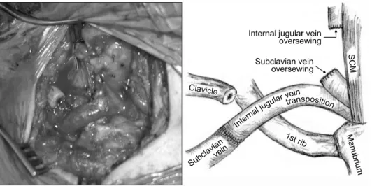 Fig. 3.  Operative finding after inter- inter-nal jugular vein transposition.