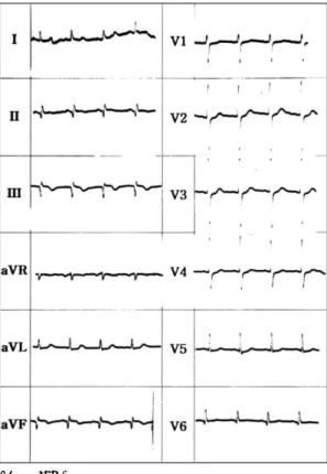 Fig. 1. EKG. 