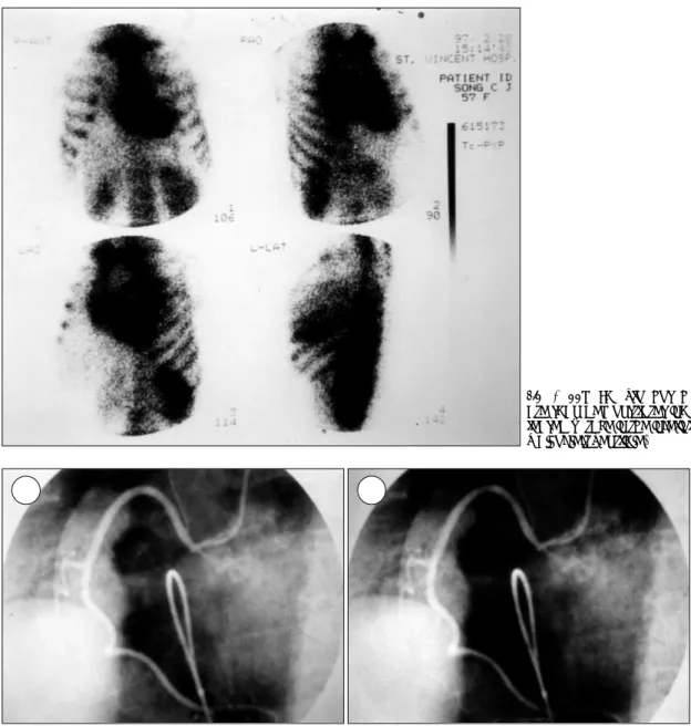 Fig. 4. Coronary angiogram (A) and ergonovine spasm test (B) show normal findings. 륜부근의 심방중격에서는 약간의 음영 증강이 보이는 3.5×2 cm 크기의 움직이는 종괴가 보였고(Fig