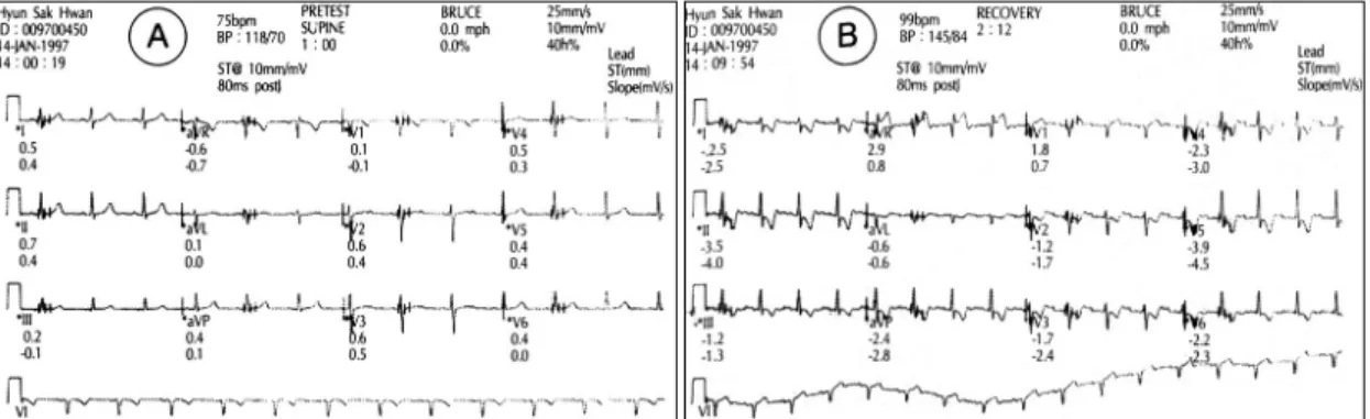 Fig. 1. Treadmill test. A) The resting EKG rhythm shows no abnormalities. B) At recovery stage, more than 2mm downsl- downsl-oping ST segment depression was noted in anteroinferior leads