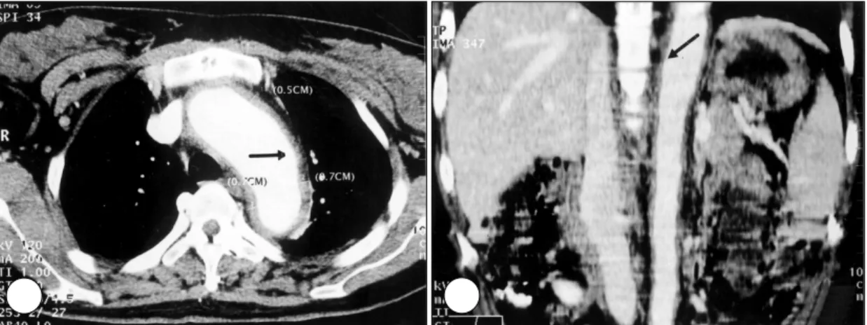 Fig. 4. CT angiography shows A) marked thickening of full circumference of the aortic wall at the level of aortic arch.