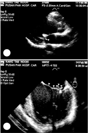 Fig. 3. A：ECG on ad- ad-mission. B：ECG during  acute pericarditis  sho-wed upward concave  ST segment elevation in  the chest and limb lead