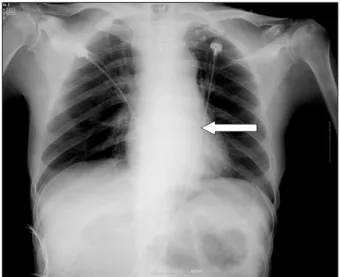 Fig. 2. The simple chest X-ray of 522nd postoperative day of the  case 12 in the aortic arch replacement group with the open  stent-graft insertion