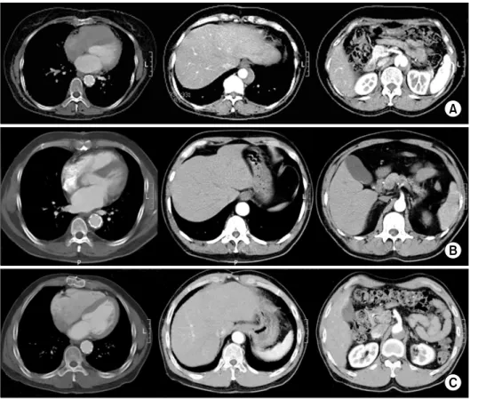 Fig. 3. The postoperative CT  scans of the hybrid aortic arch  replacement with open stent graft  insertion patients (A) 9th case,  (B) 11th case, (C) 13th case of  Table 1