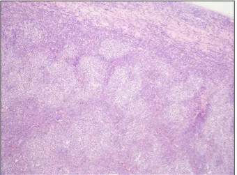 Fig. 2. Microscopic finding of diffuse large B cell lymphoma (H&amp;E  stain,  ×400). Tumor cells show diffuse growth pattern