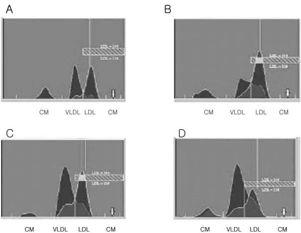 Fig.  2.  Densitometric  scanning  of  various  hyperlipidemias.  Cholesterol  and  triglyceride  are  red  and  gray,  respectively,  in  the  densitogram