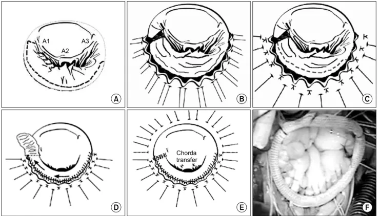 Fig. 1. (A) Extensive undercutting of PMVL. (B) Annulus plicating suture and tie down