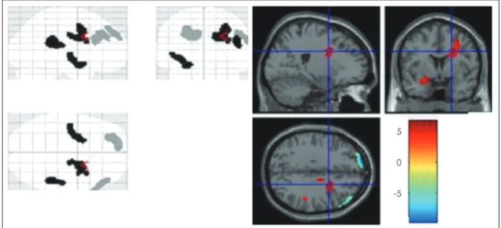 Fig. 2. Significant changes of rCBF in subjects with ADHD after methylphenidate medication