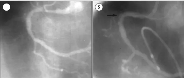 Fig. 1. Right coronary artery(RCA) in left anterior oblique projection. There was 75% eccentric stenosis in the proximal RCA(A).