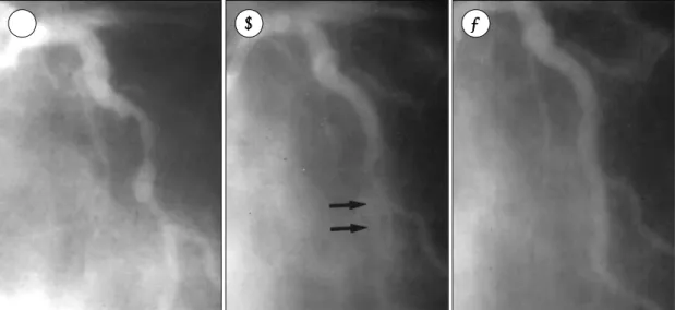 Fig. 3. Left circumflex artery in right anterior oblique projection. Prestent angiogram revealed 85% eccentric and angulated stenosis at the mid LCX(A)