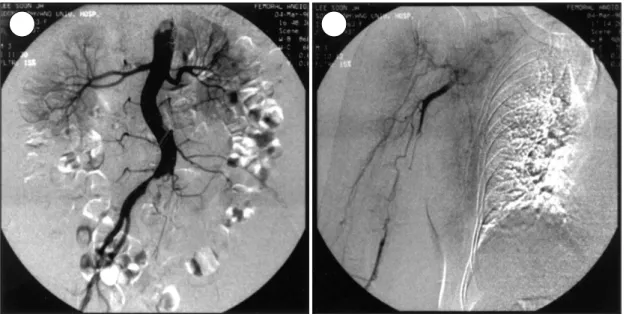 Fig. 2. Angiogram. A：Abdominal aortogram. Complete obstruction of the left common iliac artery and 70% stenosis of the right common iliac artery